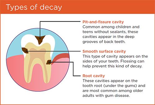 Types of tooth decay